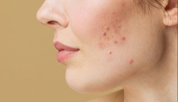 ব্রণ দূর করার ঘরোয়া প্যাক