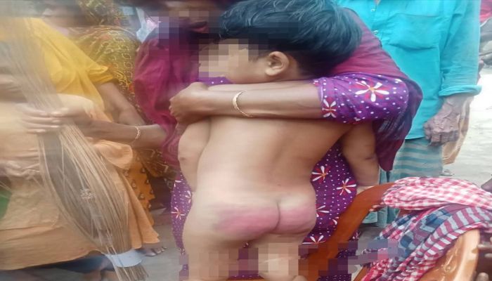 কিশোরগঞ্জের কটিয়াদী সৎ মায়ের পাষবিক নির্যাতনে ক্ষতবিক্ষত শিশুর শরীর
