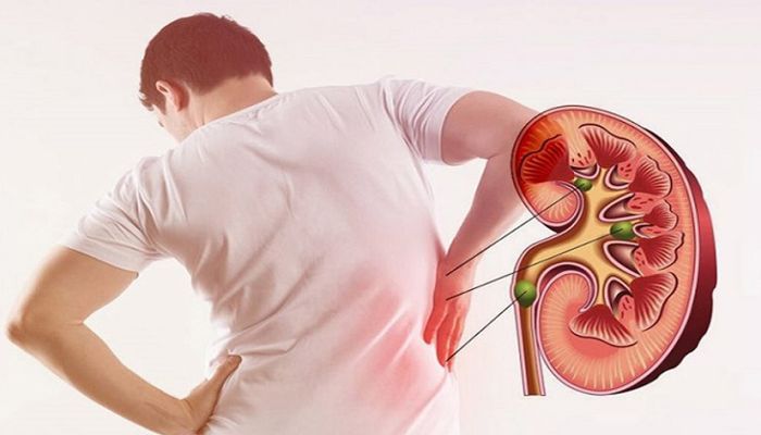 গরমে এসির ঠান্ডাতে কি কিডনিতে পাথর হয়